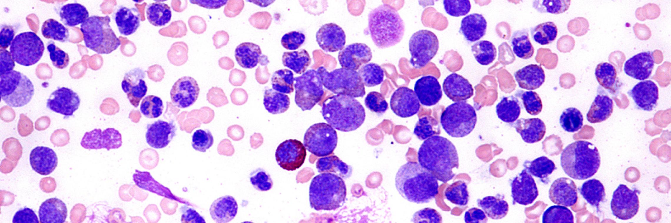 Chronische myeloische Leukämie Therapie BMSOnkologie