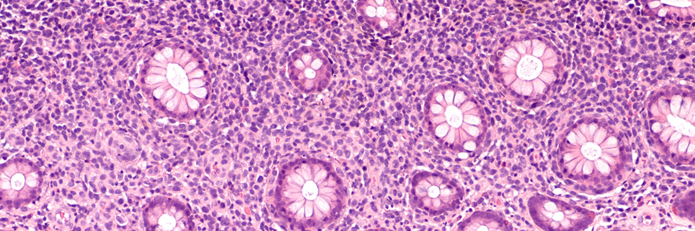 BZellLymphom Therapie BMSOnkologie